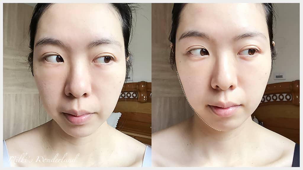 在極緻醫美打海芙音波四週後