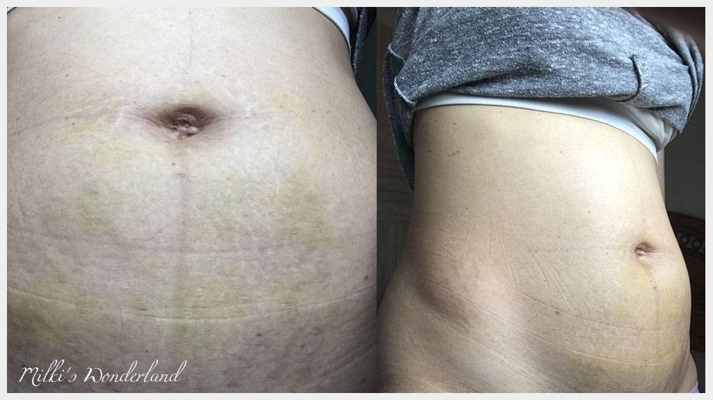 剛做完海芙音波的肚皮，相較於臉部的變化較為不明顯