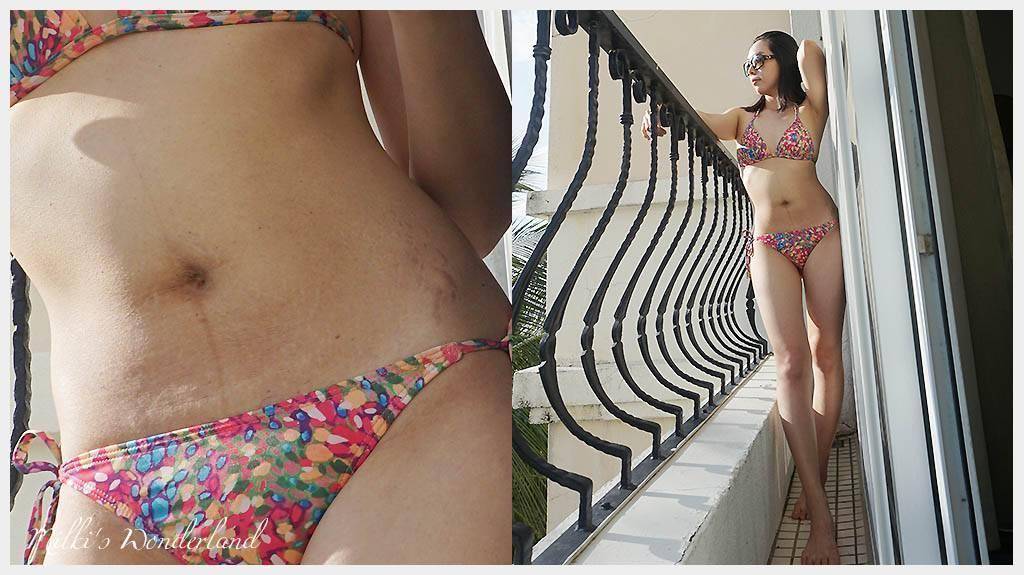 三個月後，海芙音波讓我的妊娠紋也改善不少