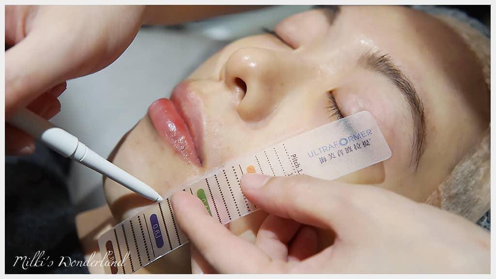 在臉上畫線是打音波的特徵喔-極緻醫美