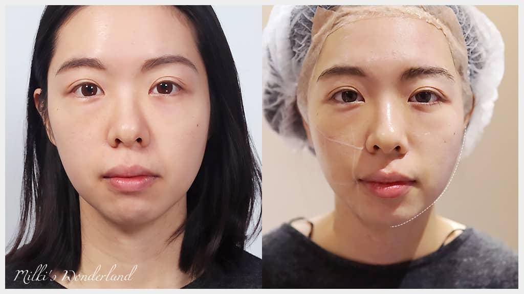 在極緻醫美打海芙音波當天就有感覺囉