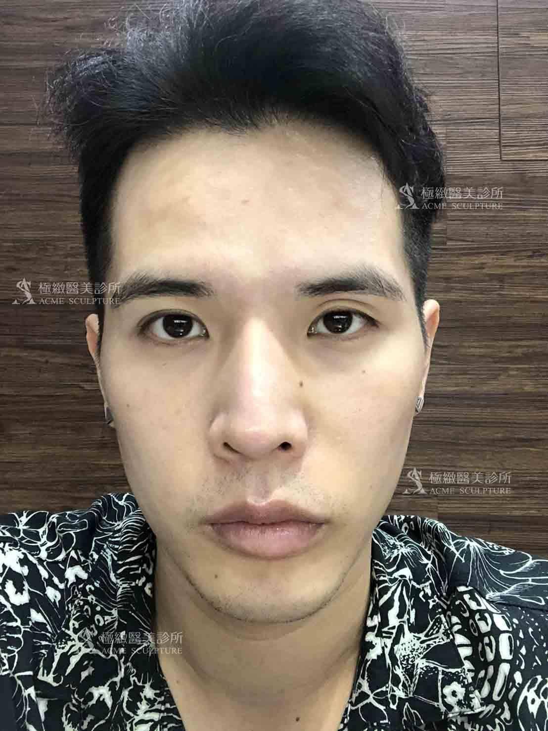 雙眼皮,縫雙眼皮,雙眼皮手術,割雙眼皮,雙眼皮術後,雙眼皮推薦,醫美雙眼皮手術,醫美眼整形,醫美雙眼皮,雙眼皮推薦,雙眼皮手術醫師