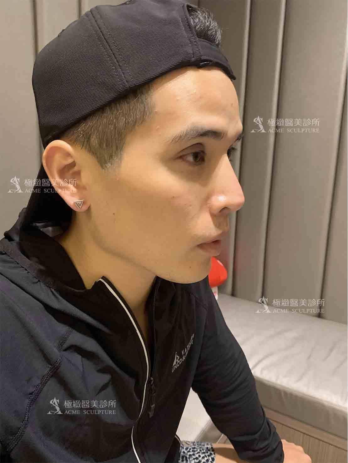 雙眼皮,縫雙眼皮,雙眼皮手術,割雙眼皮,雙眼皮術後,雙眼皮推薦,醫美雙眼皮手術,醫美眼整形,醫美雙眼皮,雙眼皮推薦,雙眼皮手術醫師