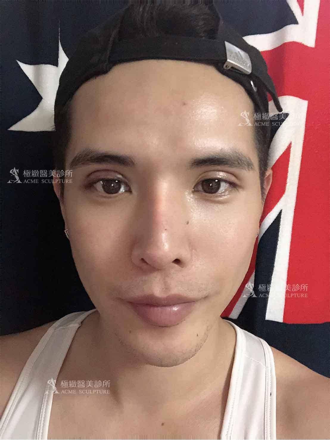 雙眼皮,縫雙眼皮,雙眼皮手術,割雙眼皮,雙眼皮術後,雙眼皮推薦,醫美雙眼皮手術,醫美眼整形,醫美雙眼皮,雙眼皮推薦,雙眼皮手術醫師
