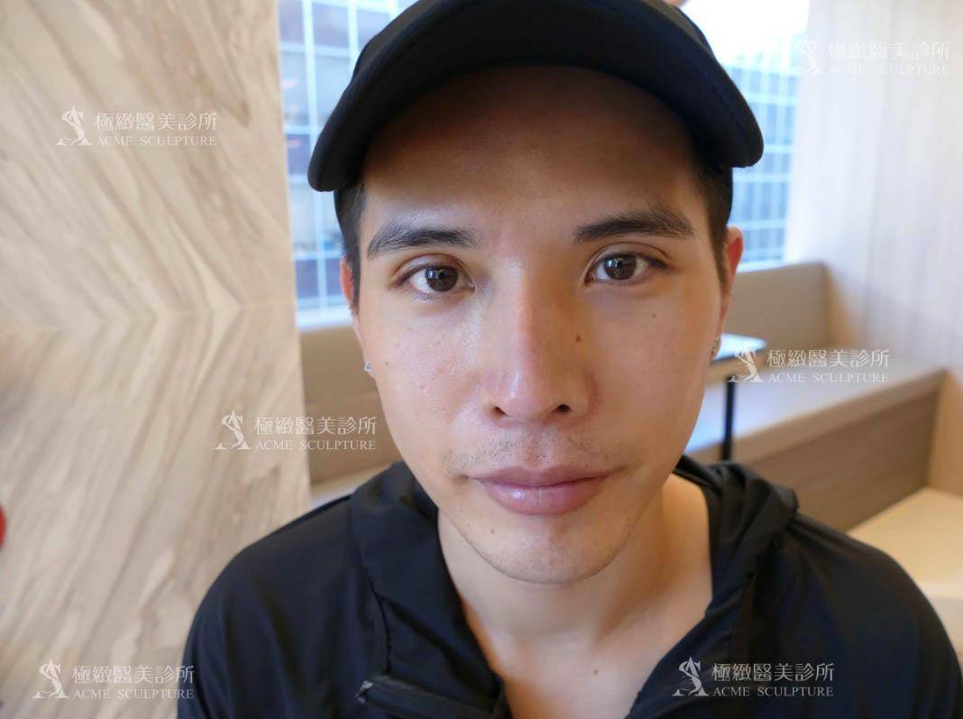 雙眼皮,縫雙眼皮,雙眼皮手術,割雙眼皮,雙眼皮術後,雙眼皮推薦,醫美雙眼皮手術,醫美眼整形,醫美雙眼皮,雙眼皮推薦,雙眼皮手術醫師